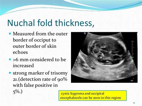 nuchal skinfold thickness measurement|when to measure nuchal fold.